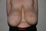 abelena.com_Pre-BR-karenau-says she was 40GG says she had 4000grams removed.jpg